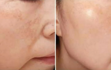 都說祛斑難，對(duì)不起，那是他因?yàn)槟銢]選對(duì)方法！